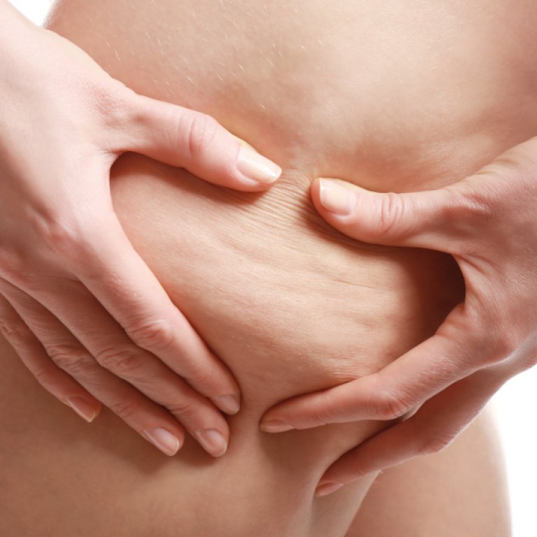 Celulitis
