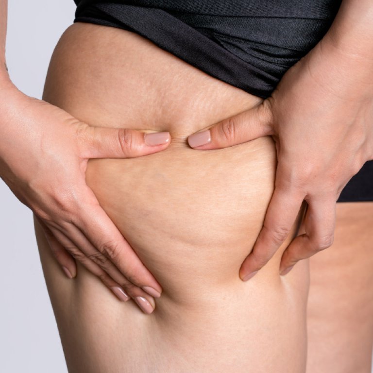 Lipedema