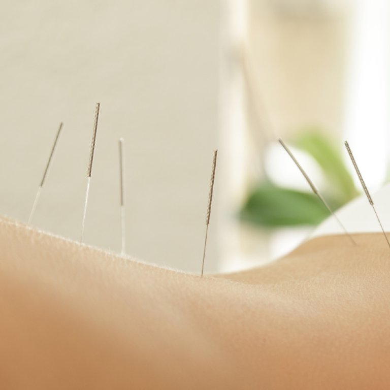 Acupuntura