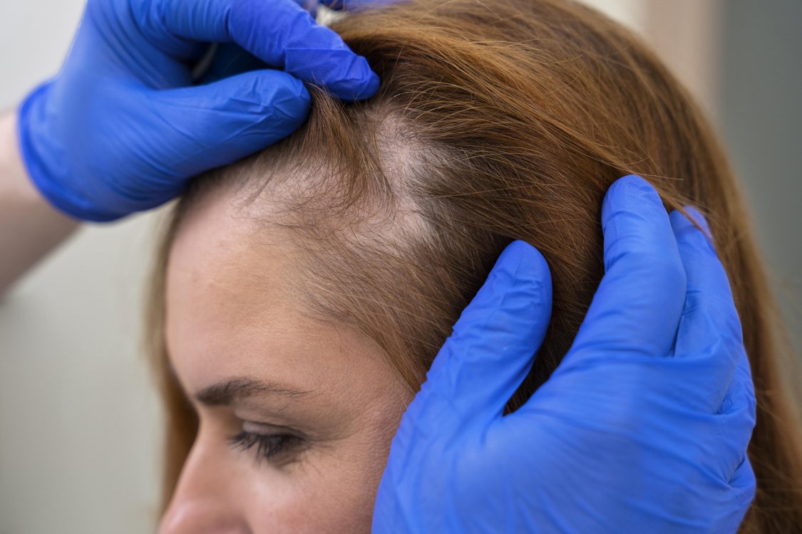 Alopecia
