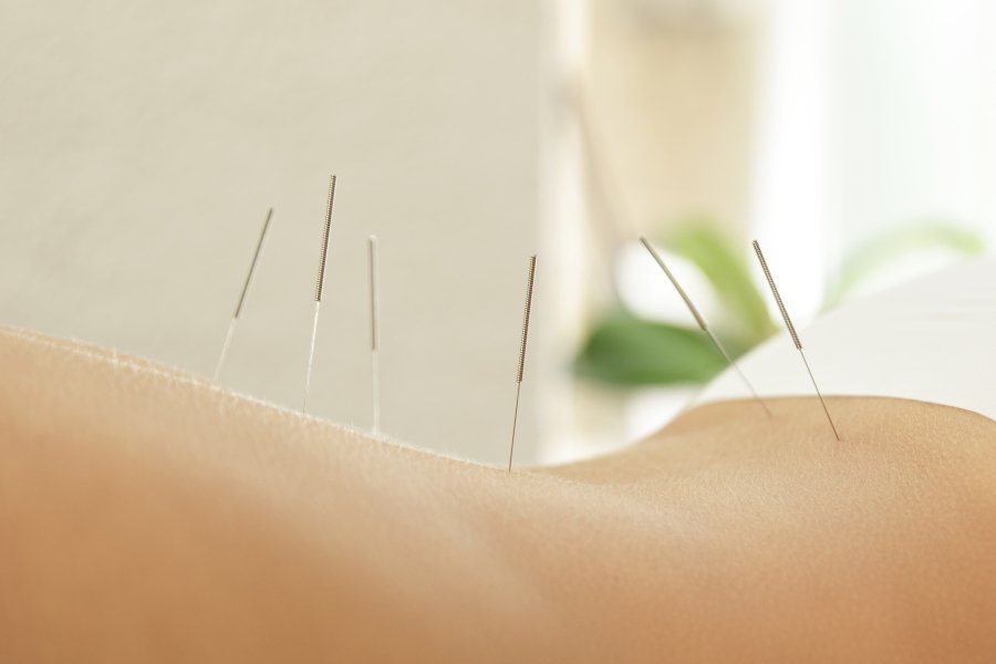 Acupuntura