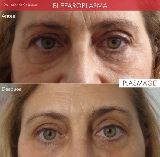 Blefaroplasma