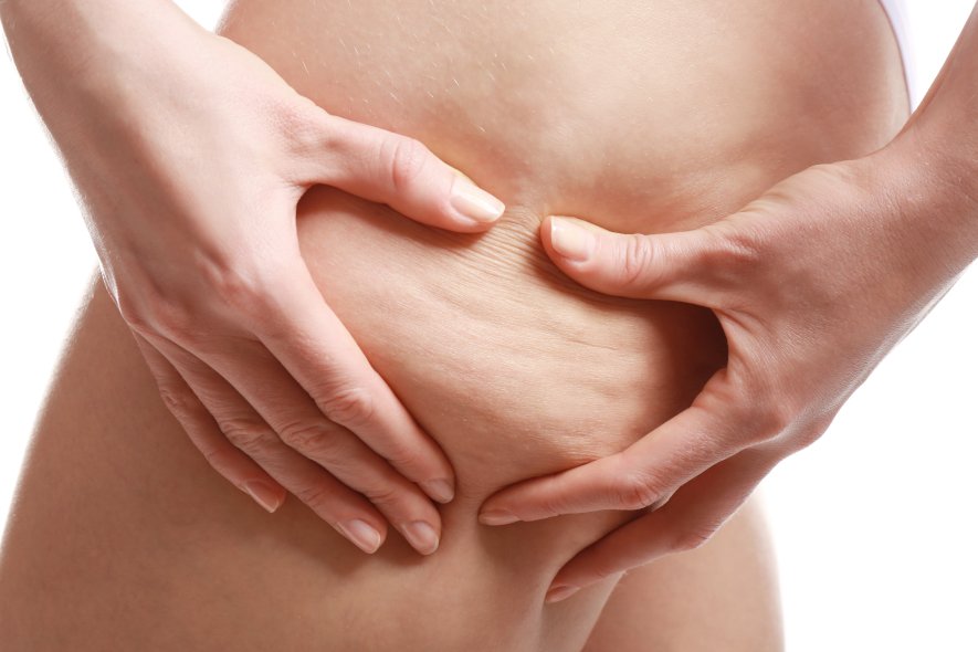 Celulitis