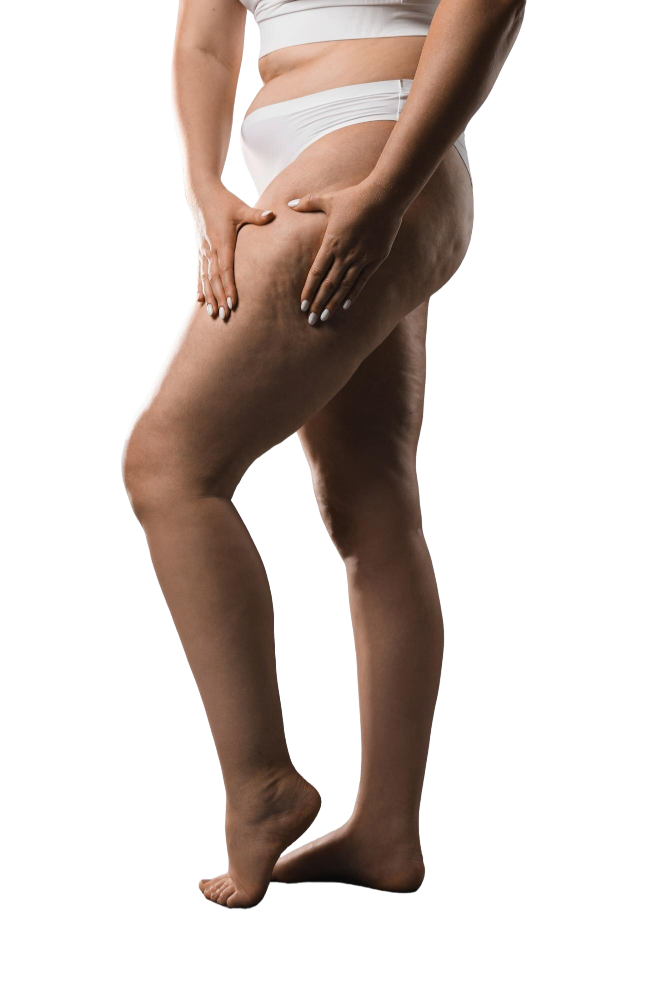 Celulitis