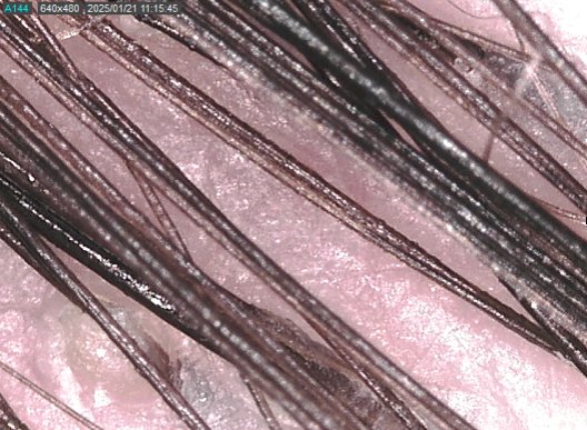 Diagnostico caída cabello