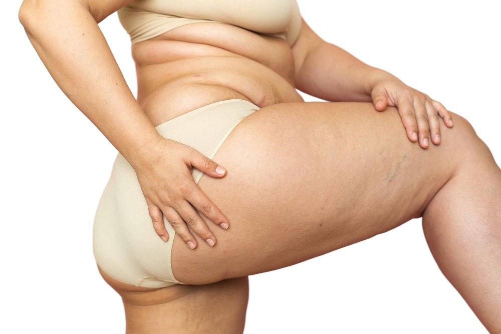 Lipedema
