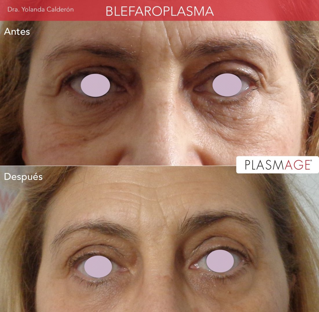 Blefaroplastia 